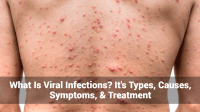 What-Is-Viral-Infections_-Its-Types-Causes-Symptoms-Treatment.png